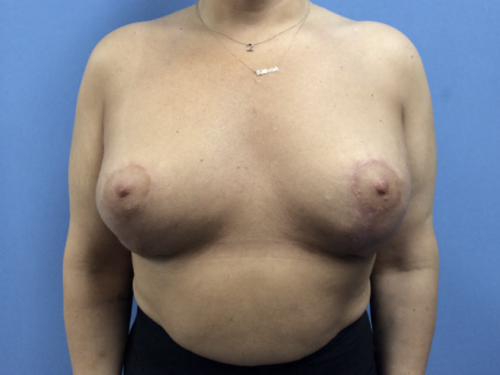 Breast-Revision-with-Lift--Case-study-3746 | After Breast Revision