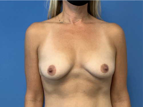 Breast-Augmentation--Case-Study-5648 | Before Breast Augmentation
