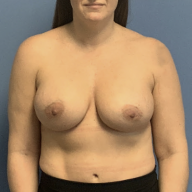 Breast-Revision--Case-Study-3749 | Before Breast Revision