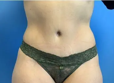 Tummy-Tuck--Case-Study-5192 | After Body