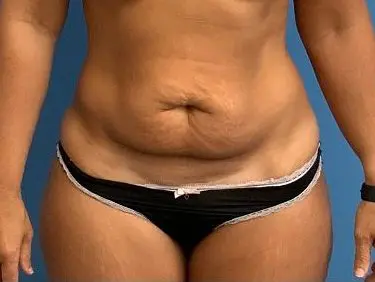 Tummy-Tuck--Case-Study-5192 | Before Body