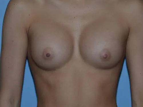 Breast-Augmentation--Case-Study-7842 | After Breast Augmentation