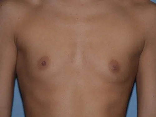 Breast-Augmentation--Case-Study-7842 | Before Breast Augmentation