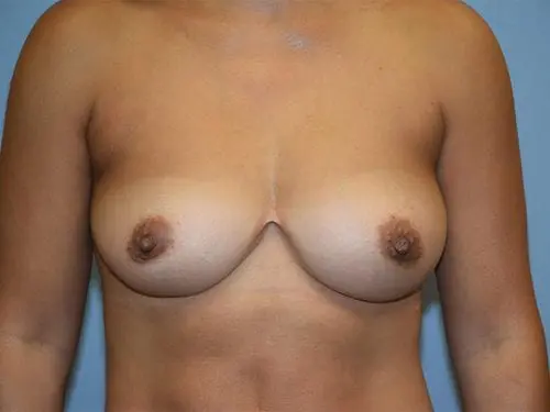 Breast-Augmentation-With-Fat-Transfer--Case-8297 | After Breast Augmentation With Fat Transfer