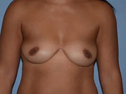 Breast-Augmentation-With-Fat-Transfer--Case-8297 | Before Breast Augmentation With Fat Transfer