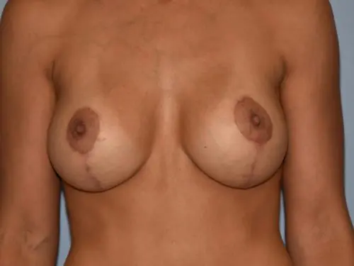 Breast-Augmentation-With-Lift--Patient-5873 | After Breast