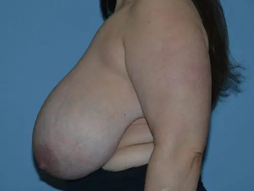Breast-Reduction-With-Lift--Case-Study-3176 | Before Breast