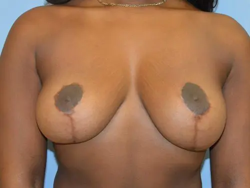 Breast-Reduction-With-Lift--Case-Study-8529 | After Breast
