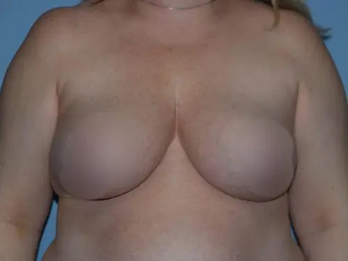 Breast-Reduction-With-Lift--Case-Study-4207 | After Breast