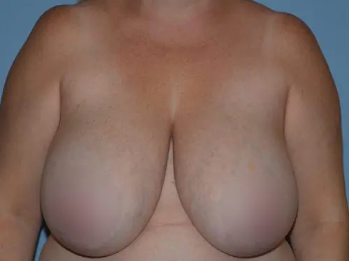 Breast-Reduction-With-Lift--Case-Study-4207 | Before Breast
