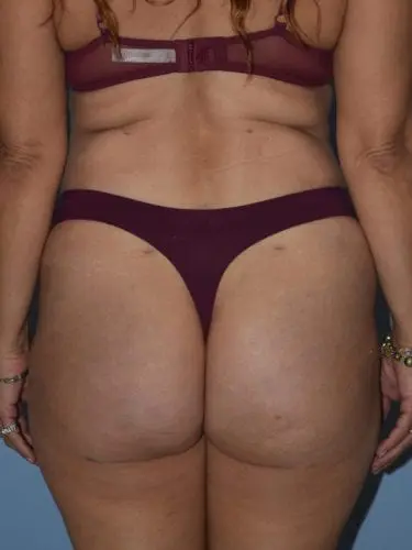 Brazilian-Butt-Lift--Case-Study-9513 | After Body