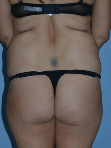 Brazilian-Butt-Lift--Case-Study-9513 | Before Body
