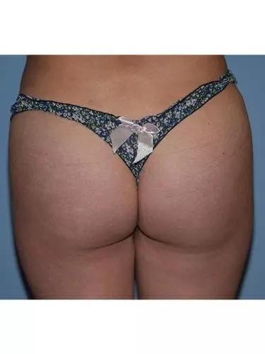 Brazilian-Butt-Lift--Case-Study-4268 | After Body