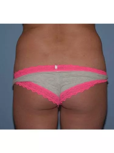 Brazilian-Butt-Lift--Case-Study-4268 | Before Body