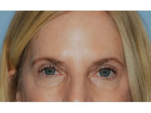 Upper-Blepharoplasty--Case-Study-6823 | After Blepharoplasty
