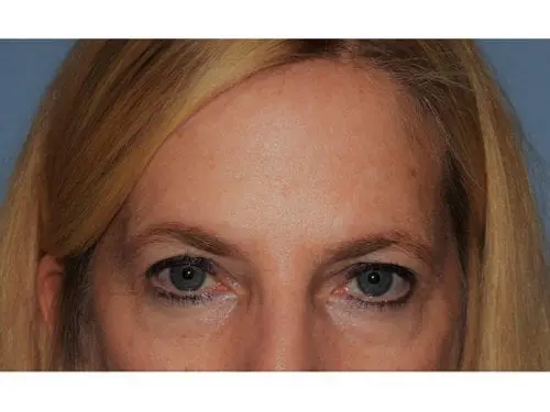 Upper-Blepharoplasty--Case-Study-6823 | Before Blepharoplasty