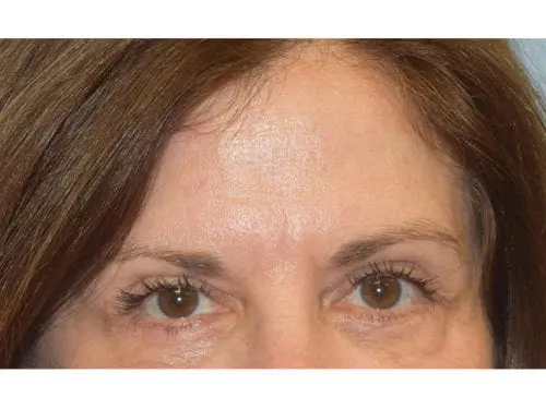 Blepharoplasty--Case-Study-9541 | After Blepharoplasty