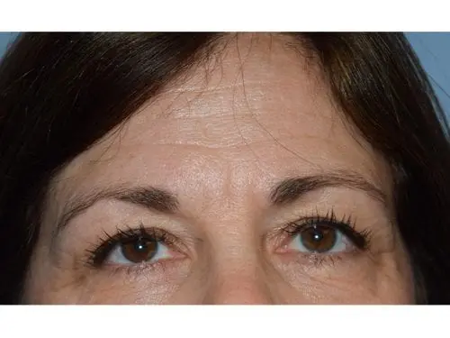 Blepharoplasty--Case-Study-9541 | Before Blepharoplasty