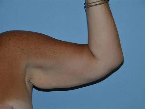 Arm-Lift--Case-Study-5741 | Before Body