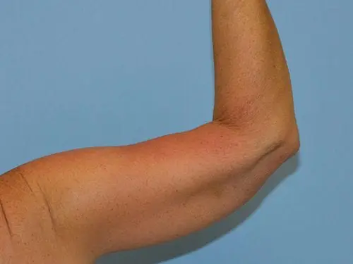 Arm-Lift--Case-Study-5741 | After Body