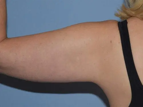 Arm-Lift--Case-Study-3187 | After Body