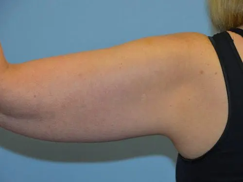 Arm-Lift--Case-Study-3187 | Before Body