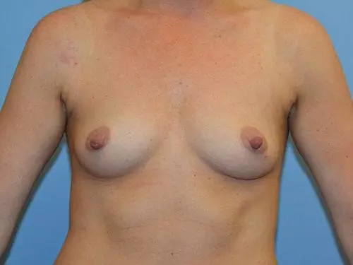 Breast-Augmentation--Case-Study-3629 | Before Breast Augmentation