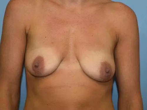 Breast-Augmentation--Case-Study-4763 | Before Breast Augmentation