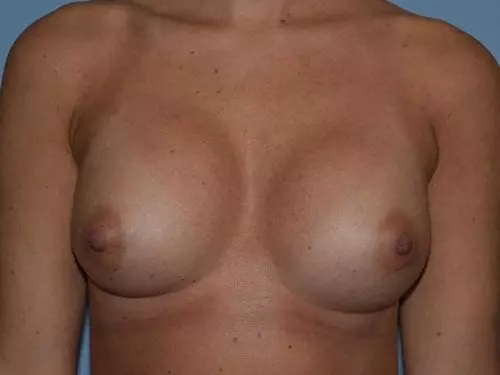 Breast-Augmentation--Case-Study-8925 | After Breast Augmentation