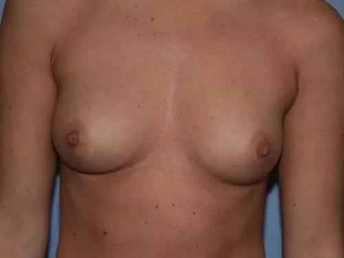 Breast-Augmentation--Case-Study-8925 | Before Breast Augmentation