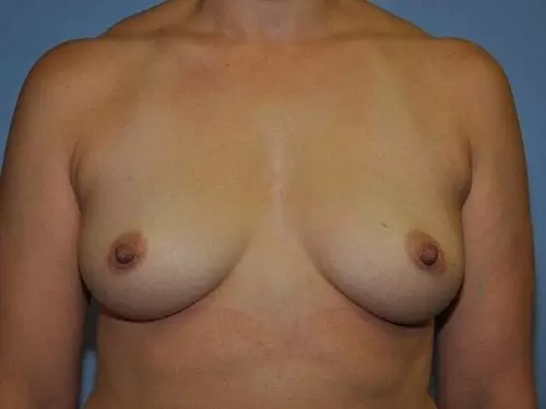 Breast-Augmentation--Case-Study-9360 | Before Breast Augmentation