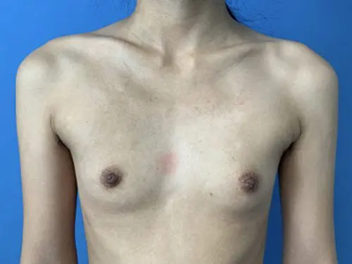 Breast-Augmentation--Case-Study-8036 | Before Breast Augmentation