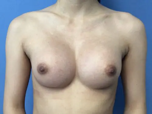 Breast-Augmentation--Case-Study-8036 | After Breast Augmentation