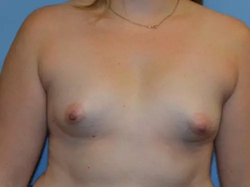 Breast-Lift--Case-Study-4730 | Before Breast