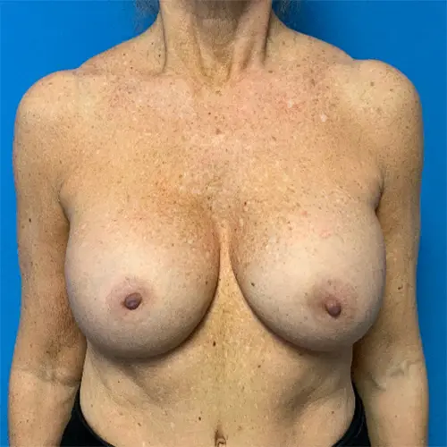 Breast-Revision--Case-Study-3178 | Before Breast Revision