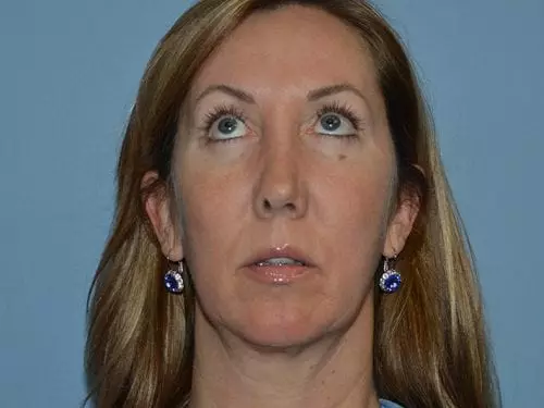 Chin-Augmentation--Case-Study-2843 | Before Chin Augmentation
