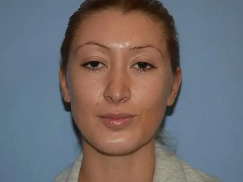 Rhinoplasty--Case-Study-6094 | After Rhinoplasty