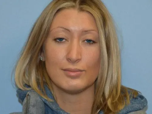Rhinoplasty--Case-Study-6094 | Before Rhinoplasty