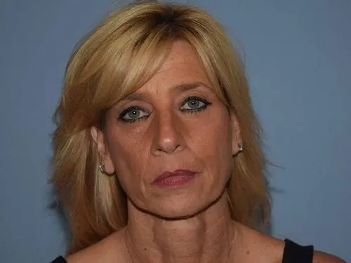 Facelift--Case-Study-4682 | Before Facelift
