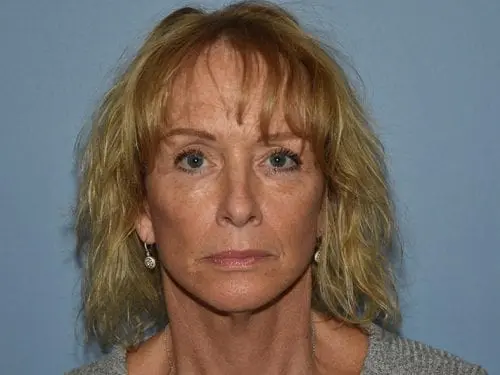 Facelift--Case-Study-9351 | After Facial Rejuvenation