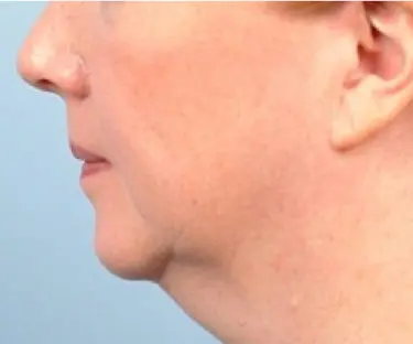 Facetite--Case-Study-3914 | Before FaceTite