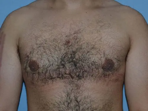 Gynecomastia--Case-Study-6391 | After Gynecomastia