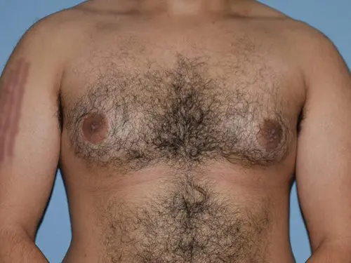 Gynecomastia--Case-Study-6391 | Before Gynecomastia