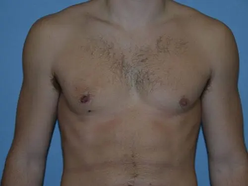 Gynecomastia--Case-Study-5270 | After Gynecomastia