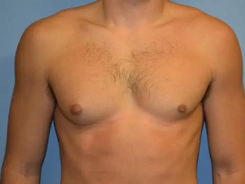 Gynecomastia--Case-Study-5270 | Before Gynecomastia