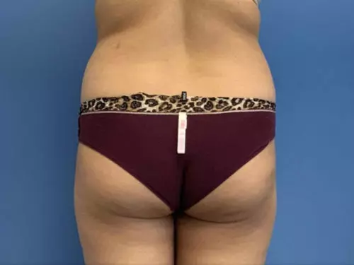 Brazilian-Butt-Lift-and-Liposuction | Before Body