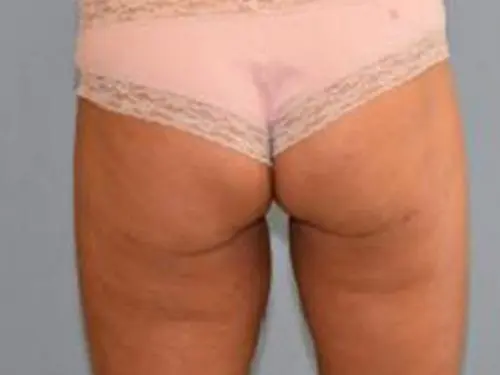 Liposuction--Case-Study-7305 | After Liposuction