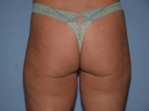 Liposuction--Case-Study-7305 | Before Liposuction
