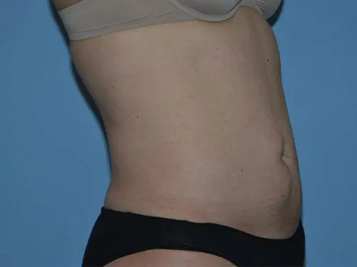 Liposuction--Case-Study-4182 | After Liposuction