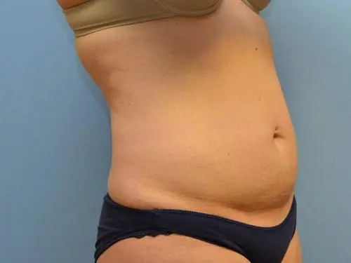 Liposuction--Case-Study-4182 | Before Liposuction